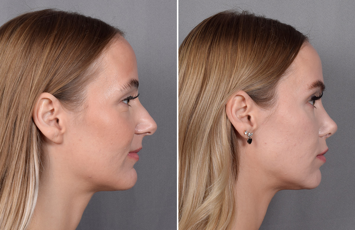 Rhinoplasty Before & After Gallery - Patient 641641 - Image 2