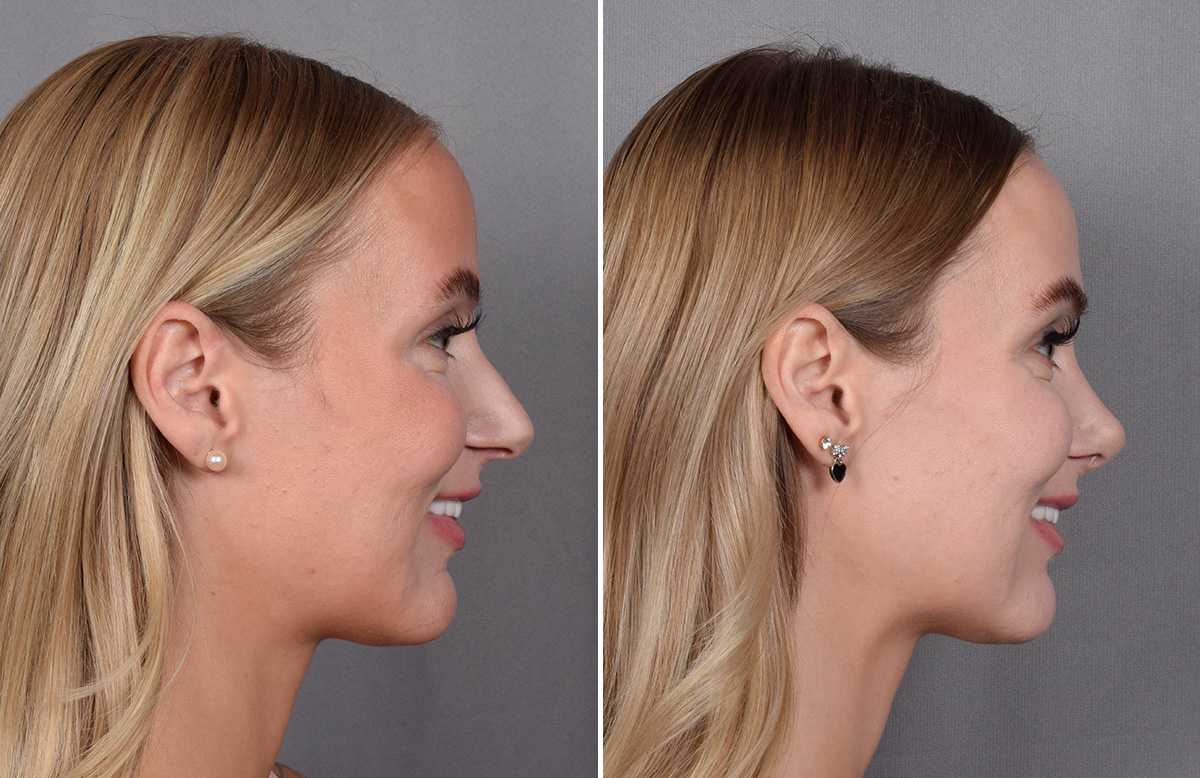 Rhinoplasty Before & After Gallery - Patient 641641 - Image 1