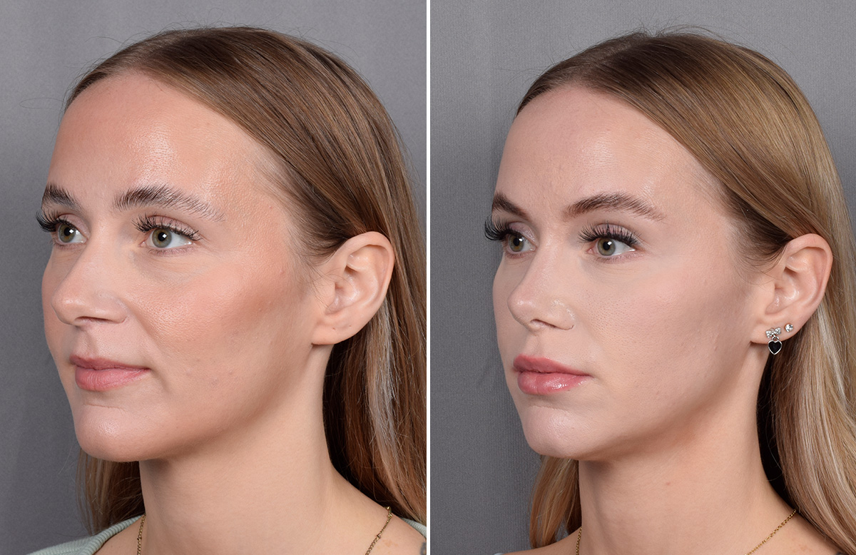 Rhinoplasty Before & After Gallery - Patient 641641 - Image 5