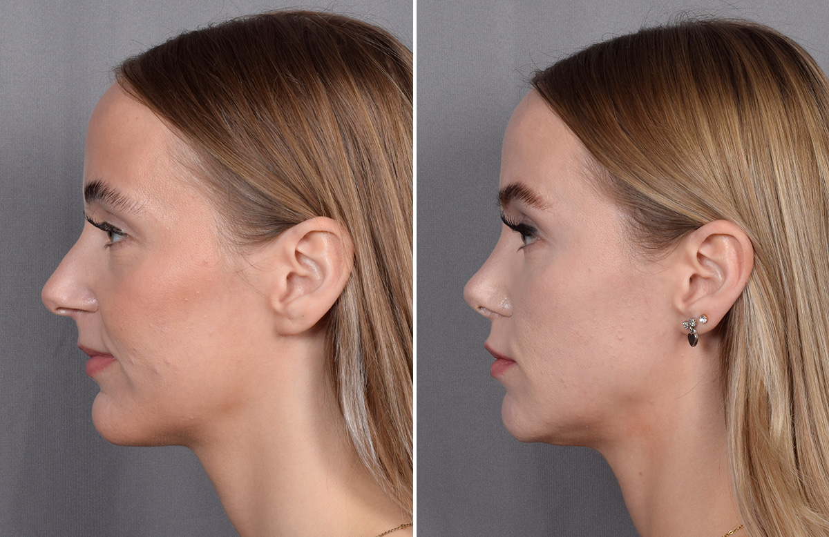 Rhinoplasty Before & After Gallery - Patient 641641 - Image 6