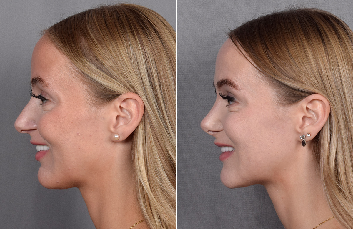 Rhinoplasty Before & After Gallery - Patient 641641 - Image 7