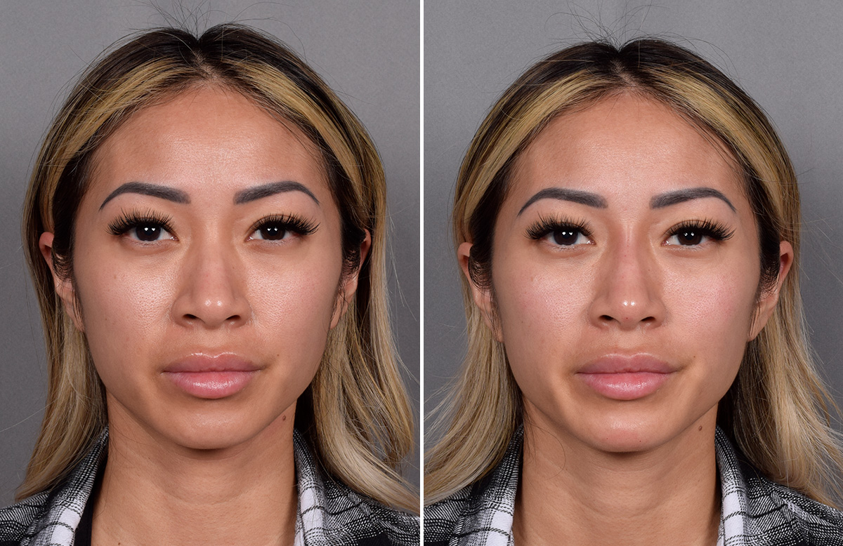 Non-Surgical Rhinoplasty Before & After Gallery - Patient 368742 - Image 3
