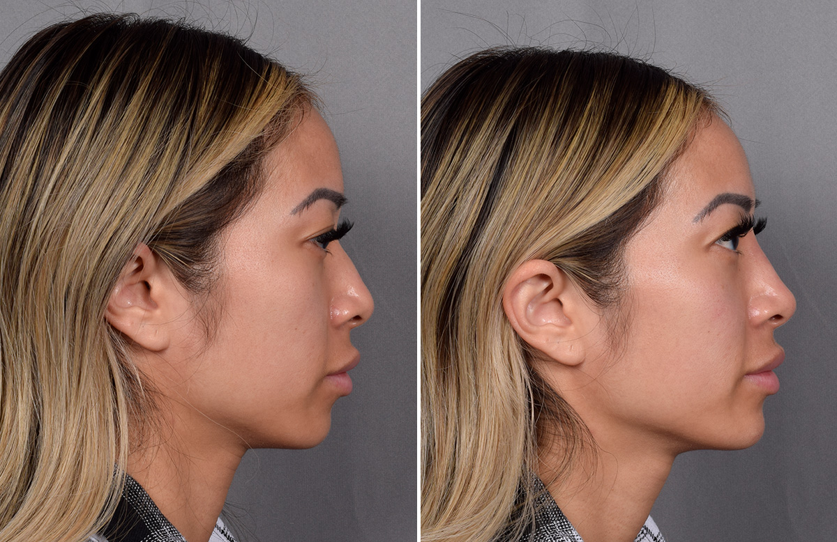 Non-Surgical Rhinoplasty Before & After Gallery - Patient 368742 - Image 1