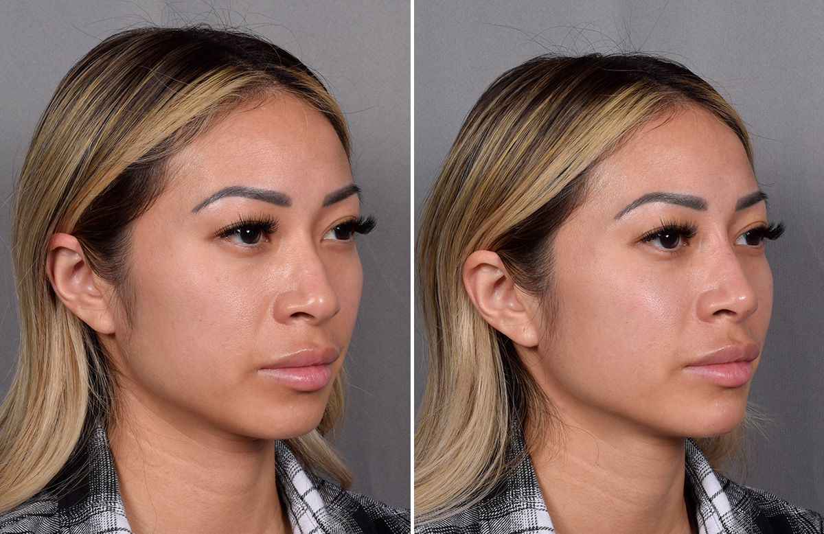 Non-Surgical Rhinoplasty Before & After Gallery - Patient 368742 - Image 2