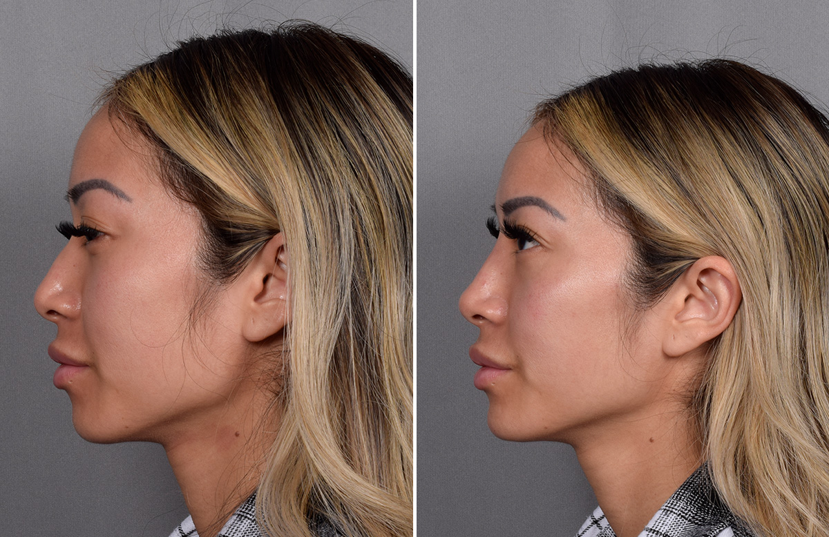 Non-Surgical Rhinoplasty Before & After Gallery - Patient 368742 - Image 5