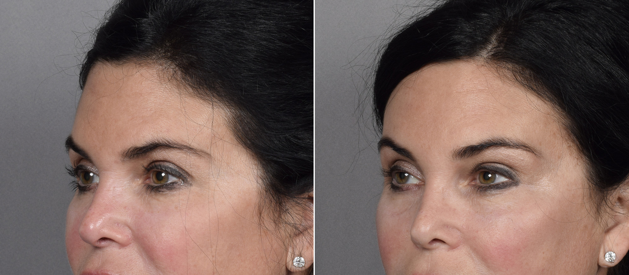 Brow Lift Before & After Gallery - Patient 396720 - Image 4
