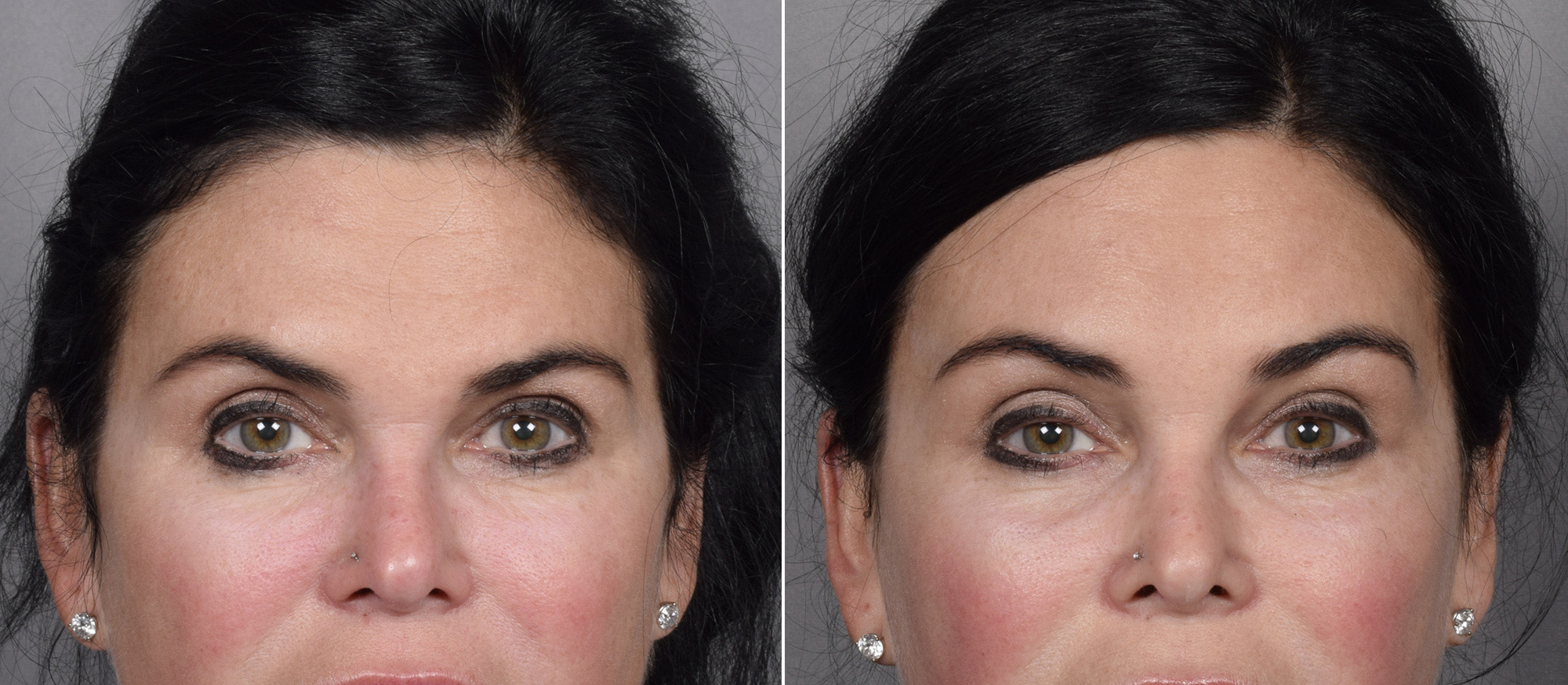 Brow Lift Before & After Gallery - Patient 396720 - Image 1