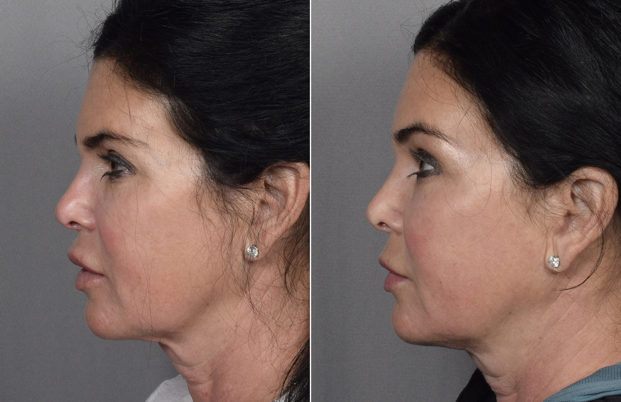 Brow Lift Before & After Gallery - Patient 396720 - Image 10