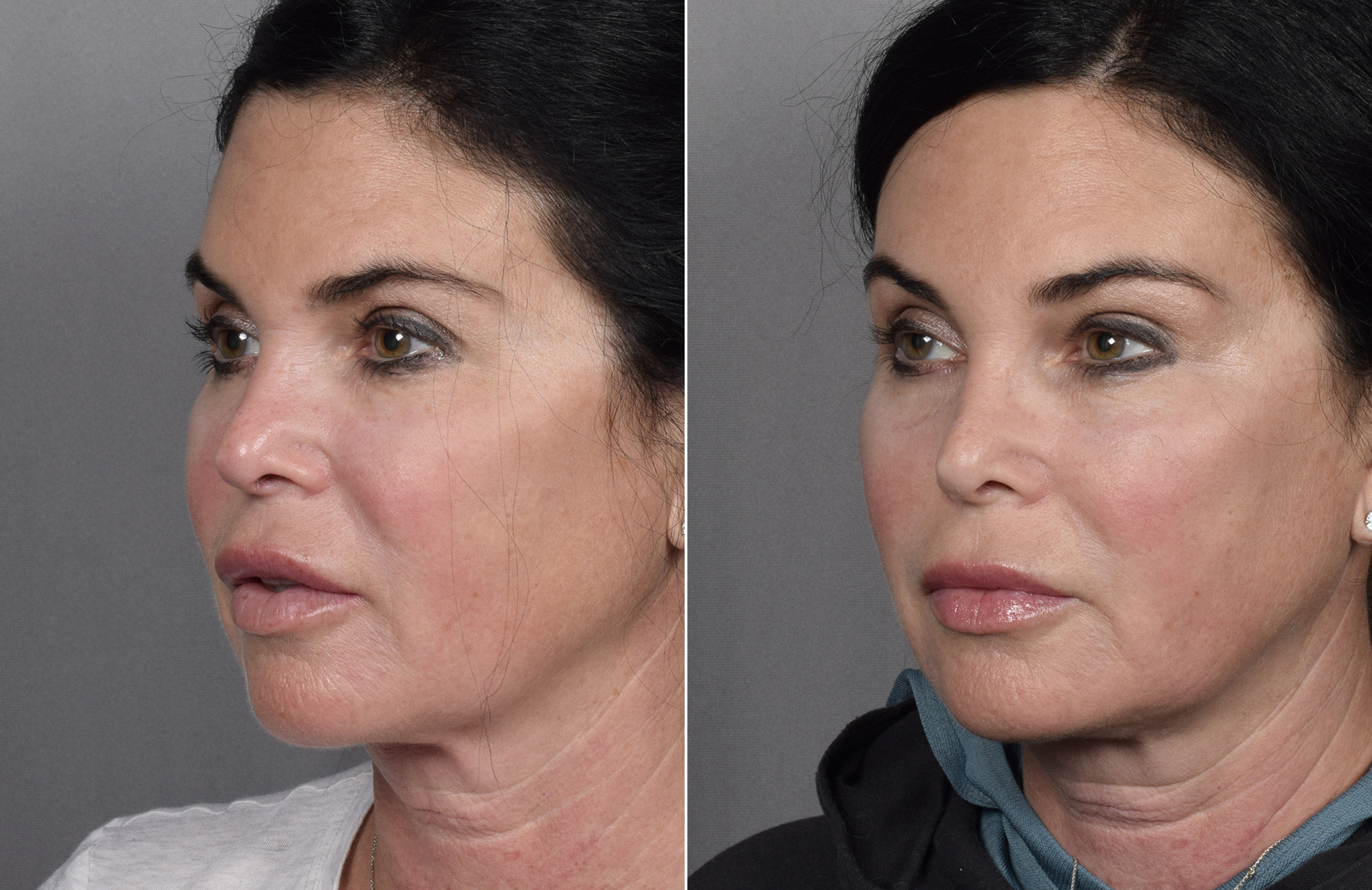Brow Lift Before & After Gallery - Patient 396720 - Image 8