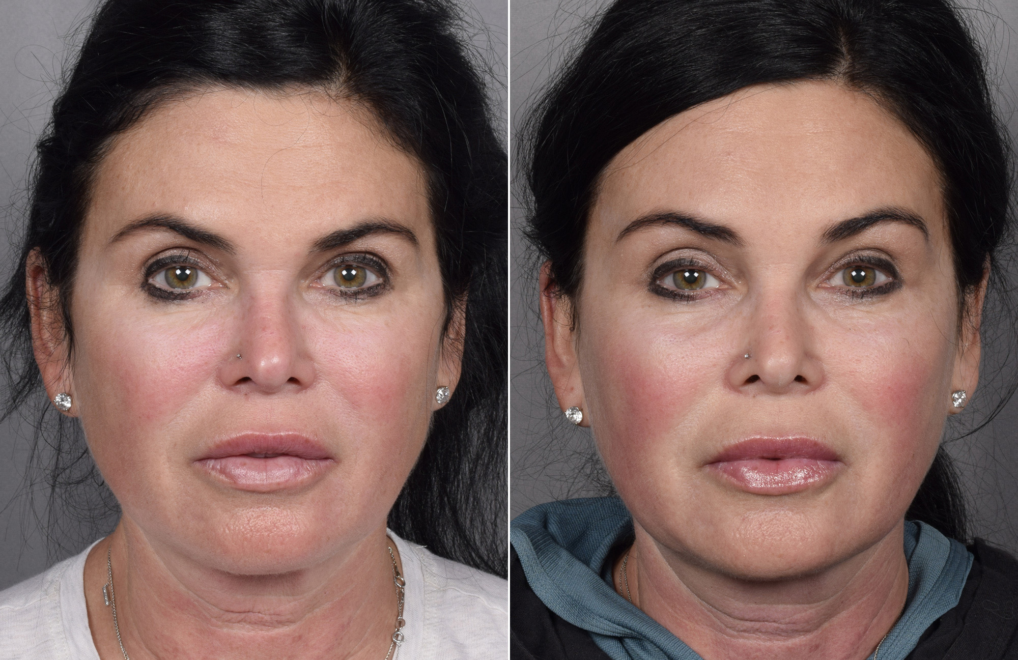Brow Lift Before & After Gallery - Patient 396720 - Image 6