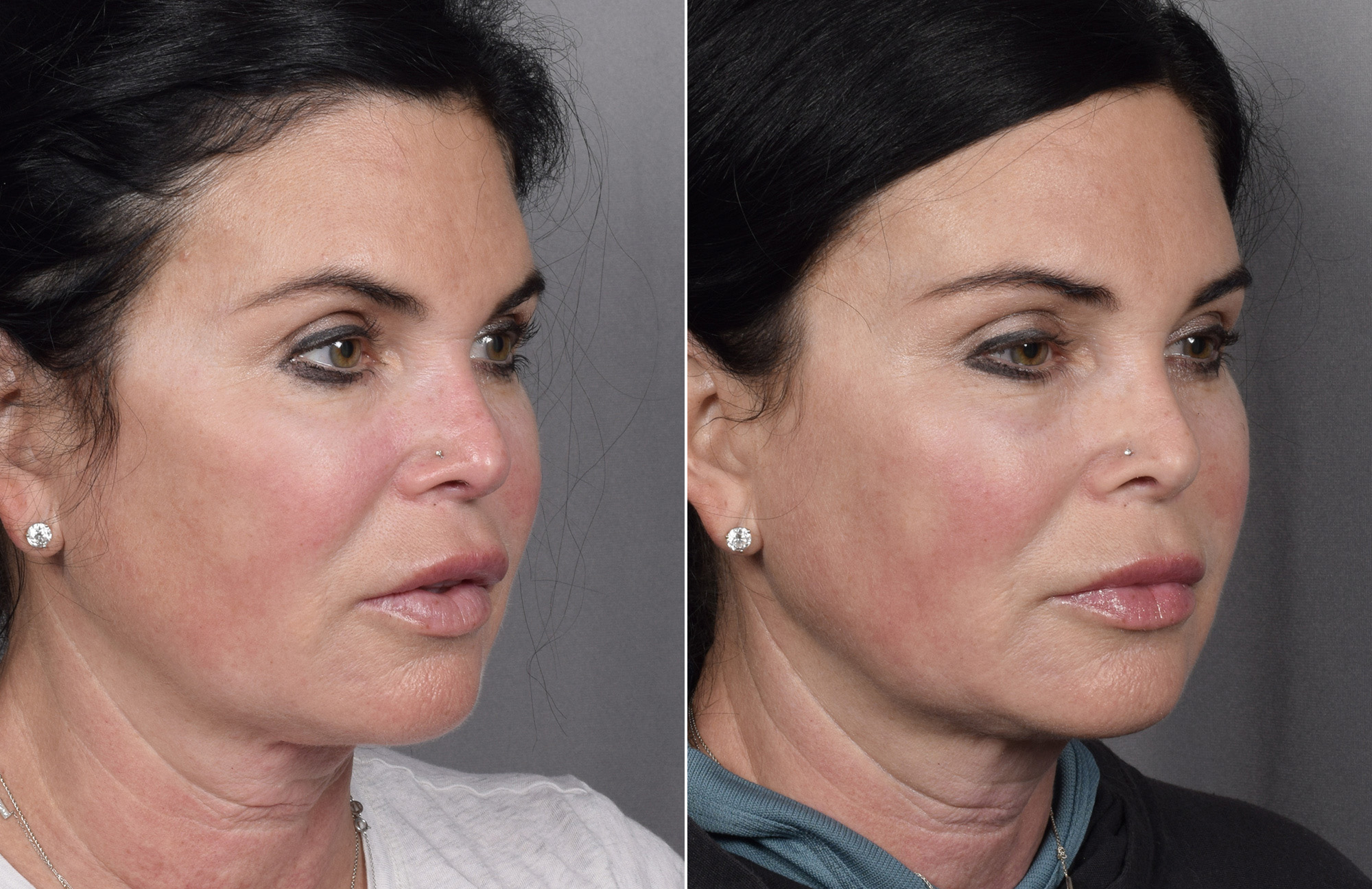 Brow Lift Before & After Gallery - Patient 396720 - Image 7