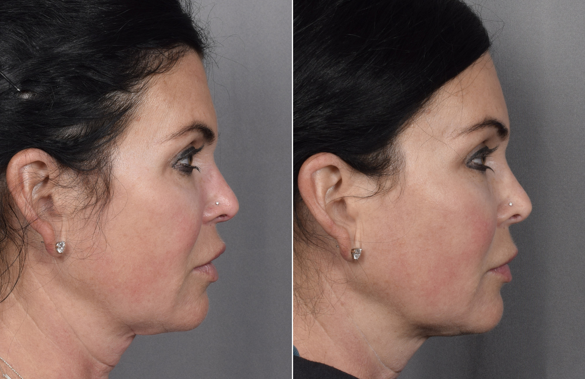 Brow Lift Before & After Gallery - Patient 396720 - Image 9