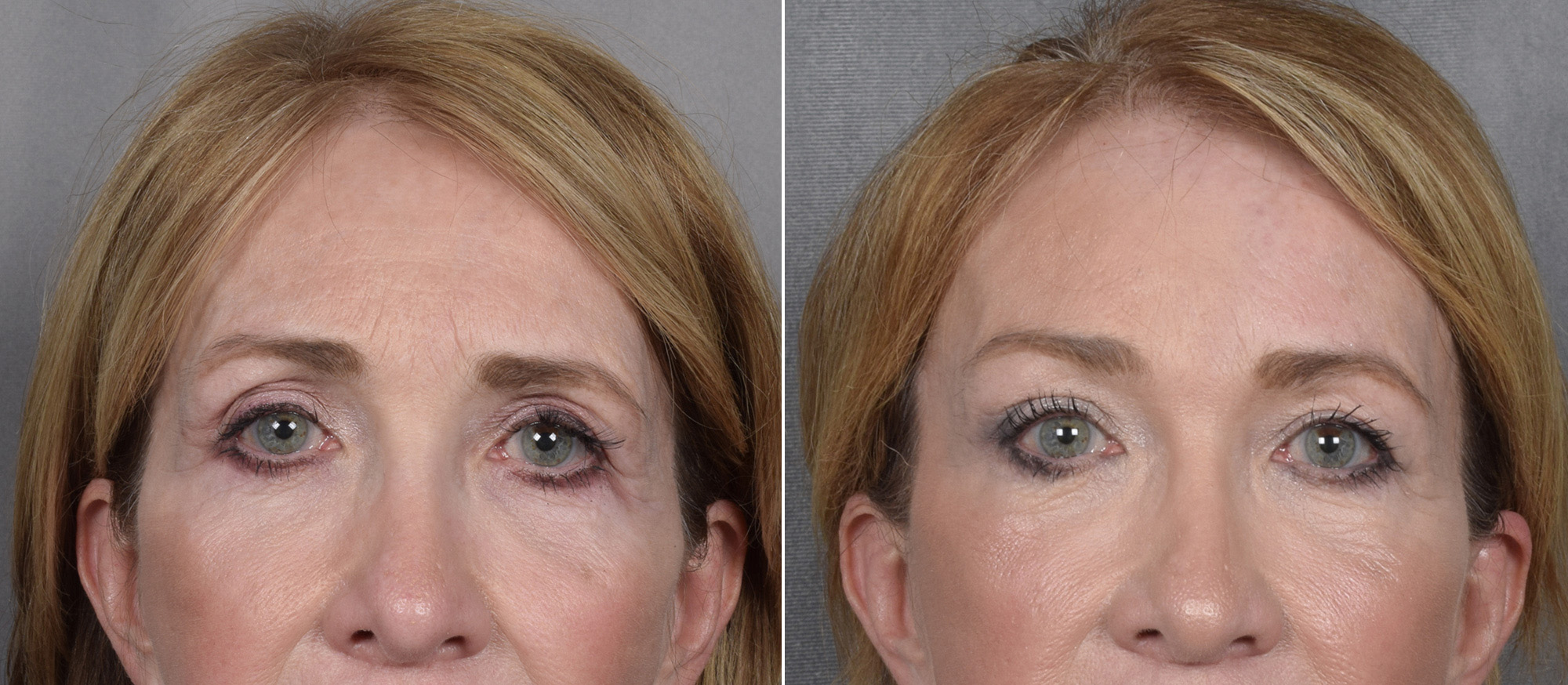 Brow Lift Before & After Gallery - Patient 211257 - Image 1