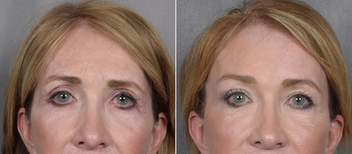 Brow Lift Before & After Gallery - Patient 211257 - Image 1
