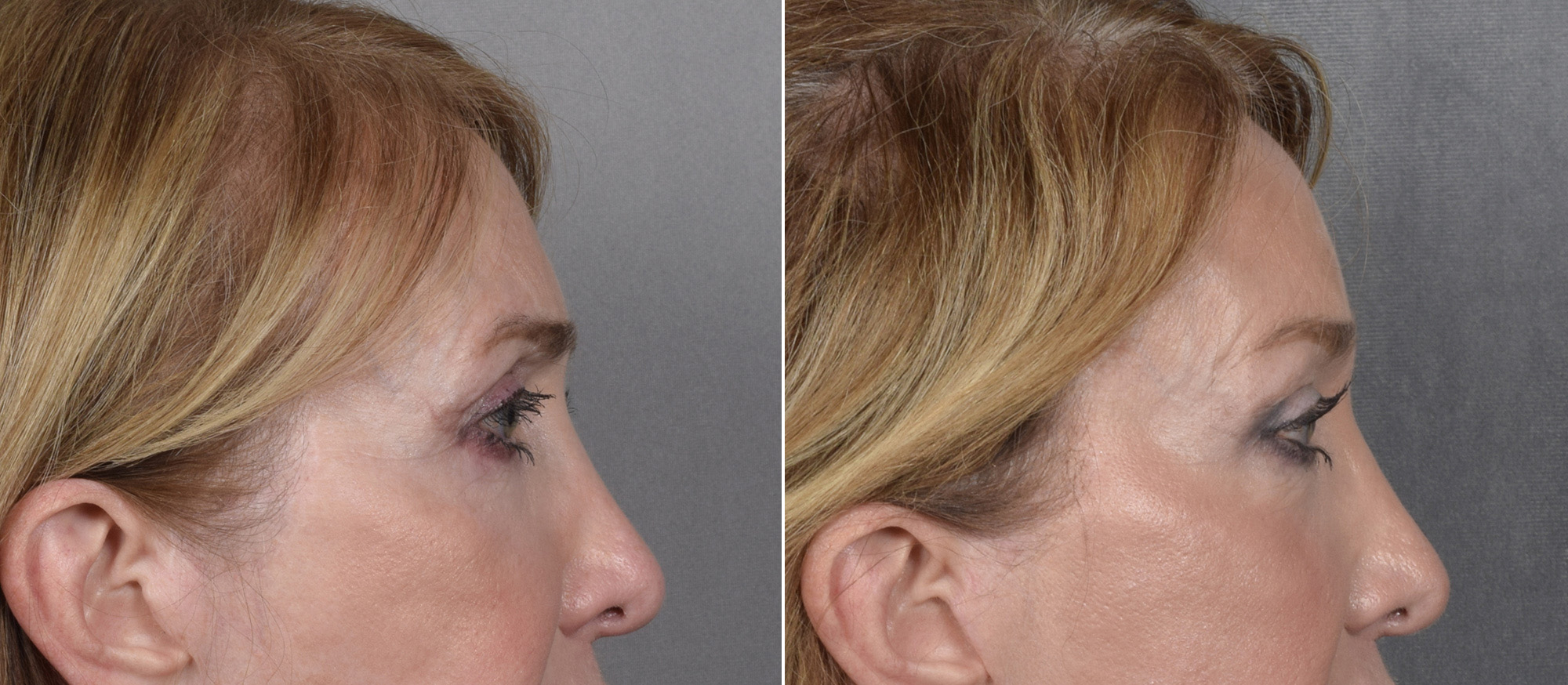 Brow Lift Before & After Gallery - Patient 211257 - Image 2
