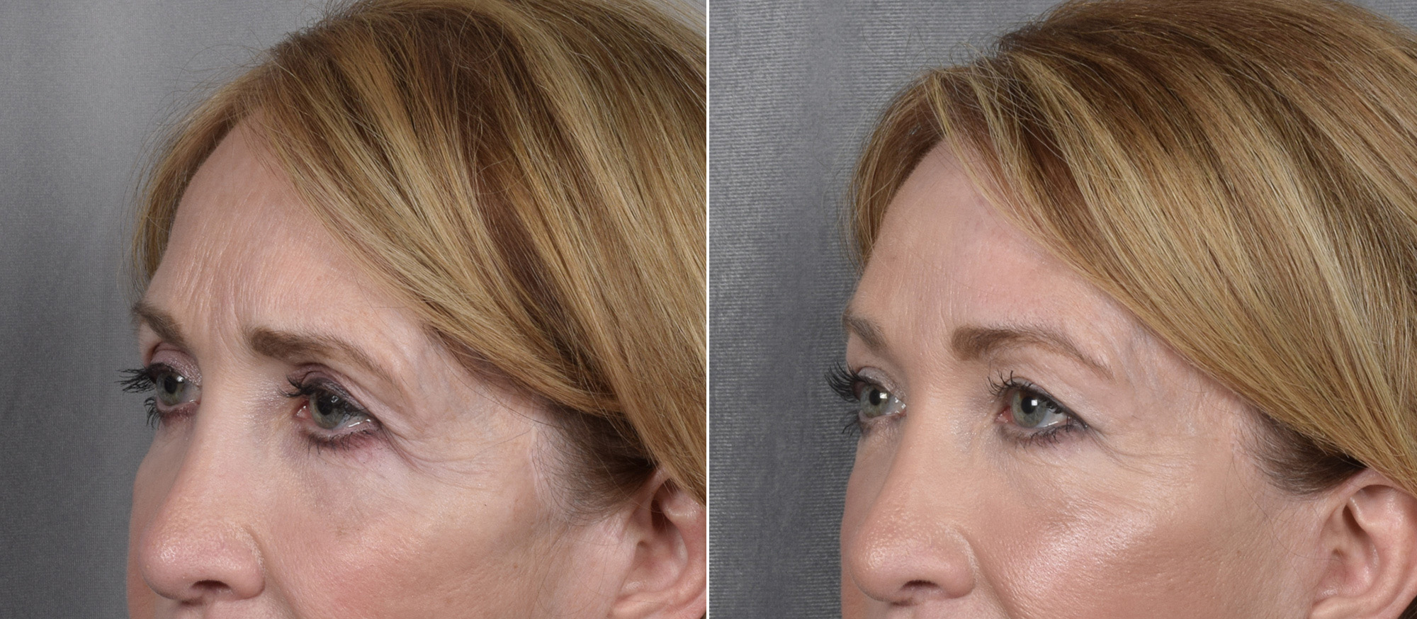 Brow Lift Before & After Gallery - Patient 211257 - Image 3