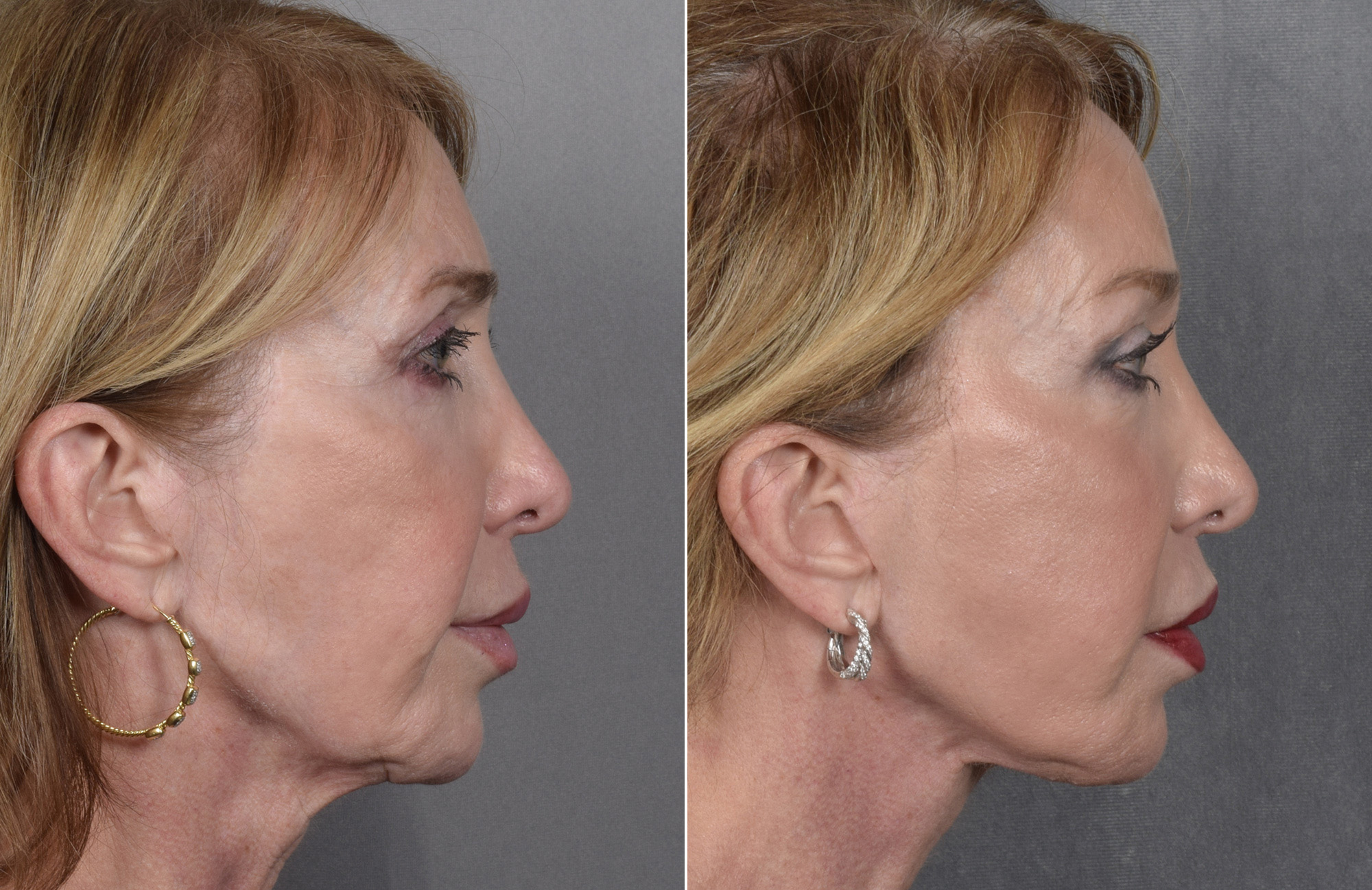 Brow Lift Before & After Gallery - Patient 211257 - Image 6