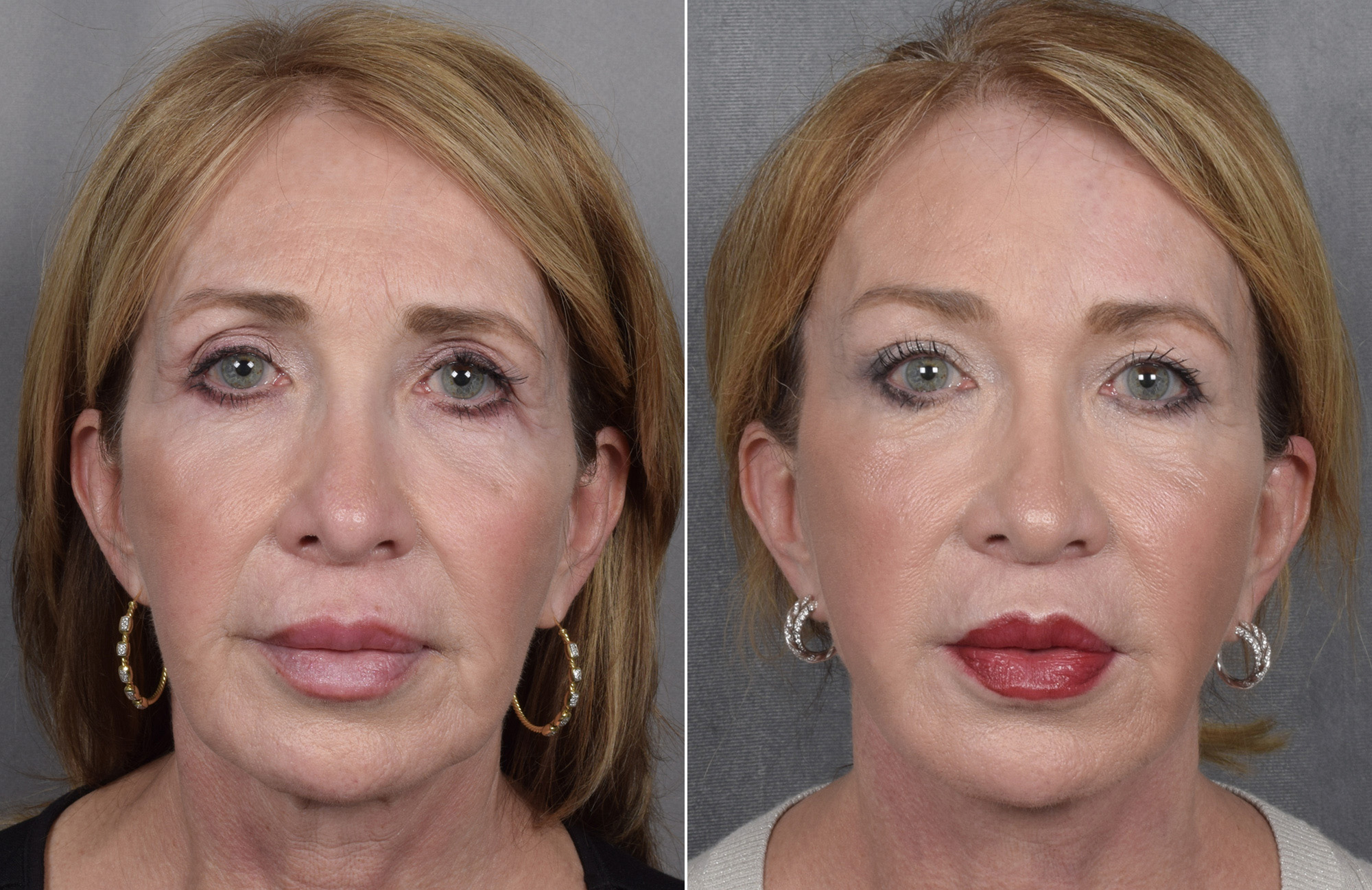 Brow Lift Before & After Gallery - Patient 211257 - Image 5