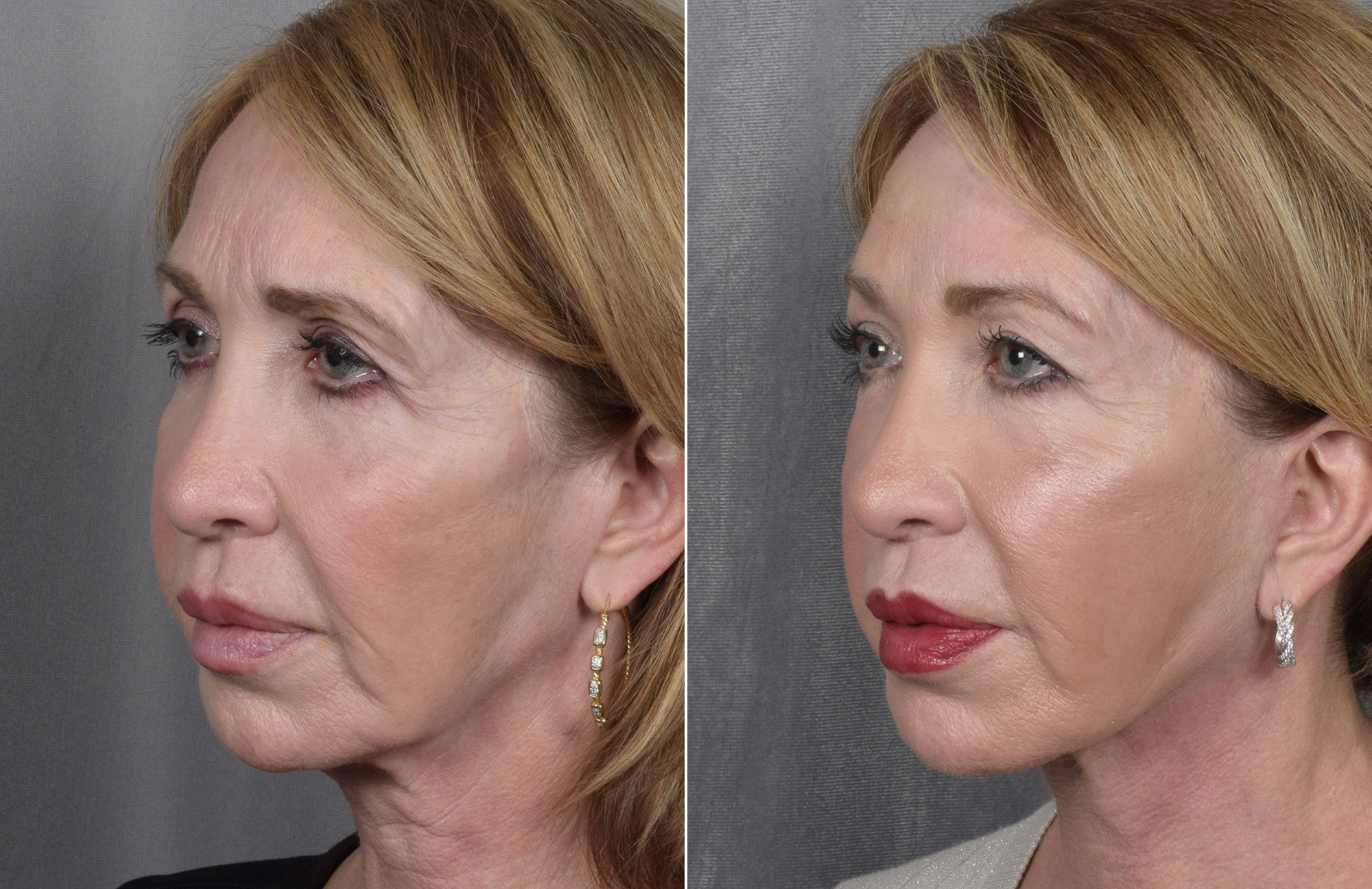 Brow Lift Before & After Gallery - Patient 211257 - Image 7