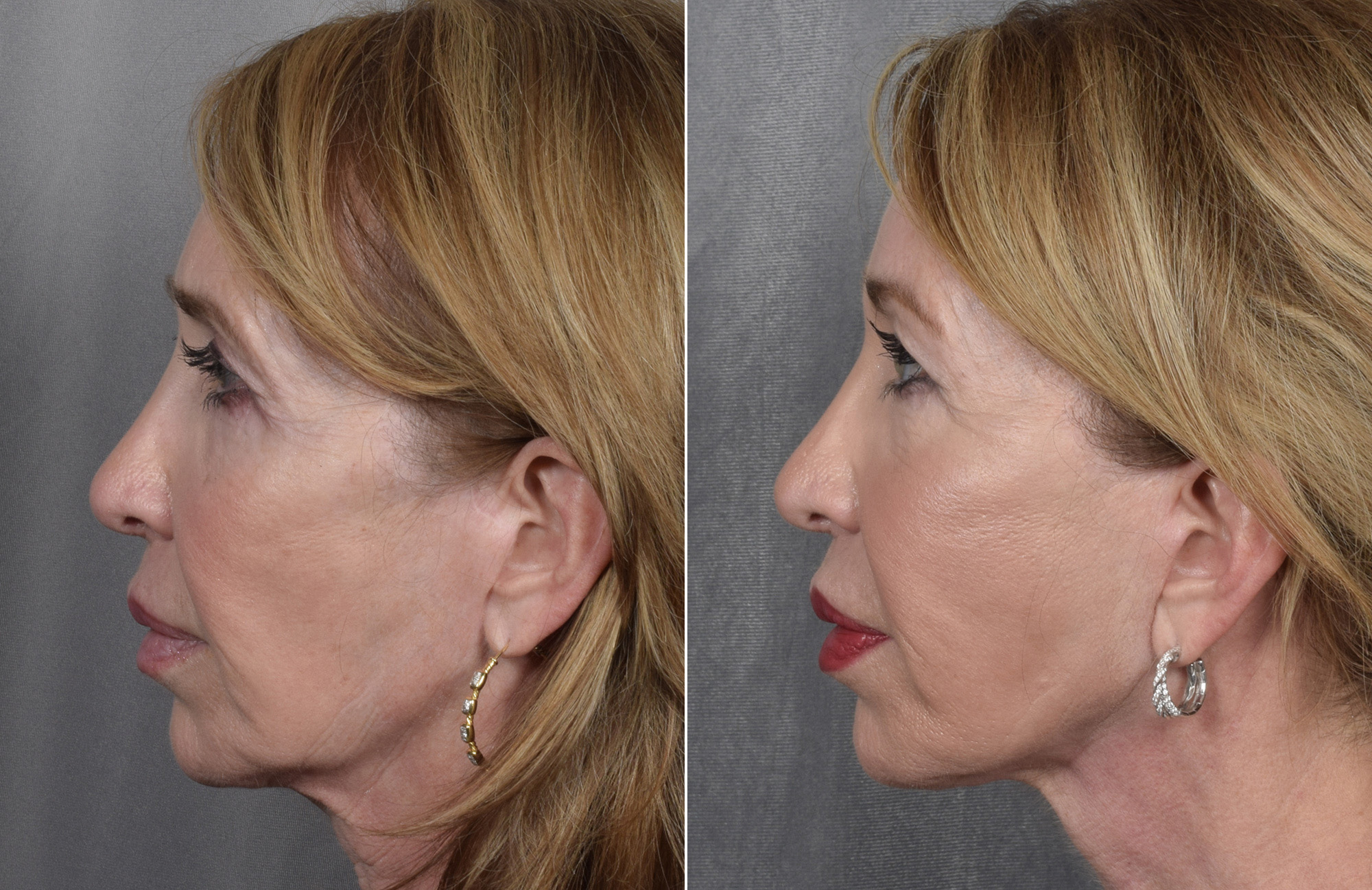 Brow Lift Before & After Gallery - Patient 211257 - Image 8