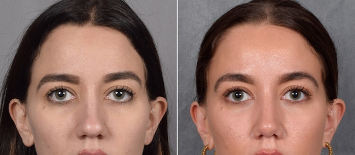 Brow Lift Before & After Gallery - Patient 436805 - Image 1
