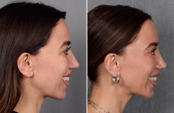 Rhinoplasty Before & After Gallery - Patient 693510 - Image 1