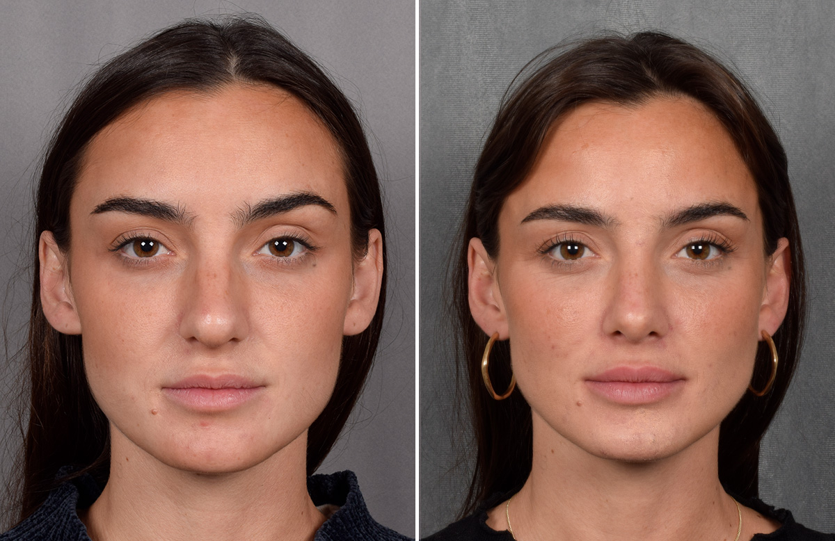 Rhinoplasty Before & After Gallery - Patient 315427 - Image 4
