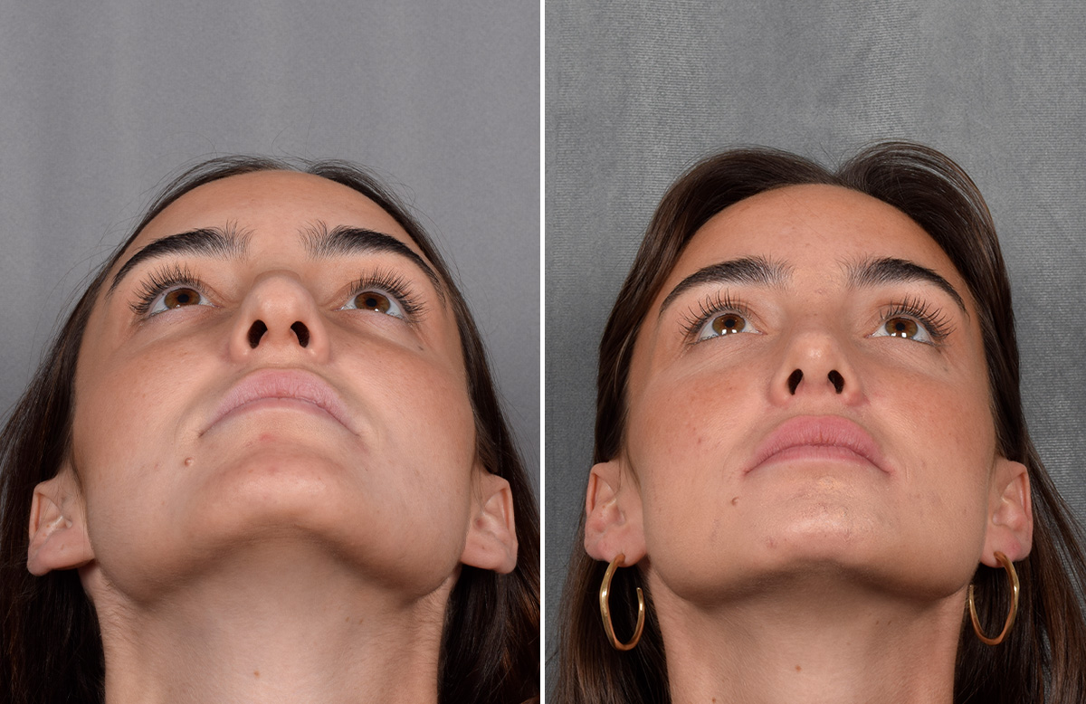 Rhinoplasty Before & After Gallery - Patient 315427 - Image 5