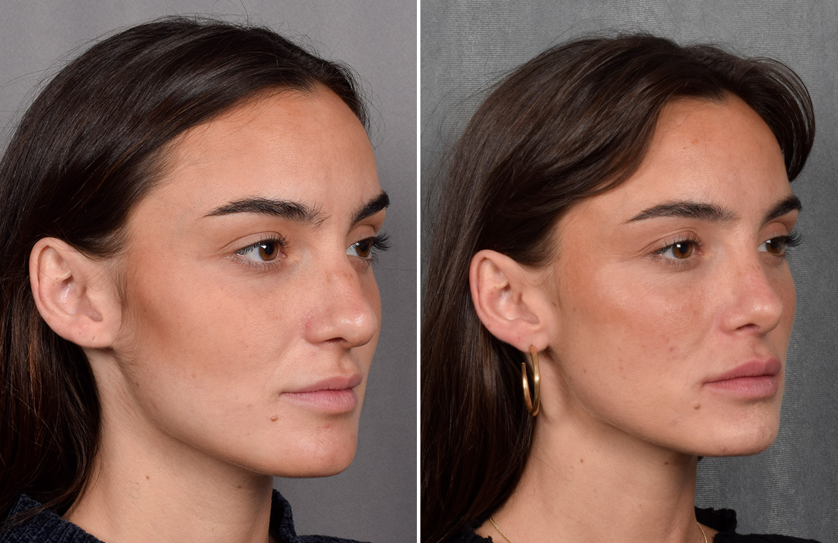 Rhinoplasty Before & After Gallery - Patient 315427 - Image 3