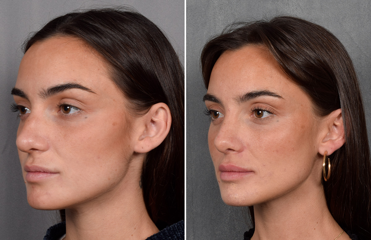 Rhinoplasty Before & After Gallery - Patient 315427 - Image 6