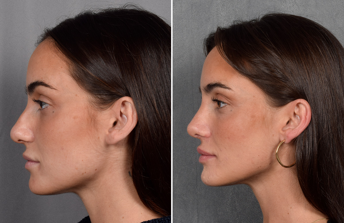 Rhinoplasty Before & After Gallery - Patient 315427 - Image 7