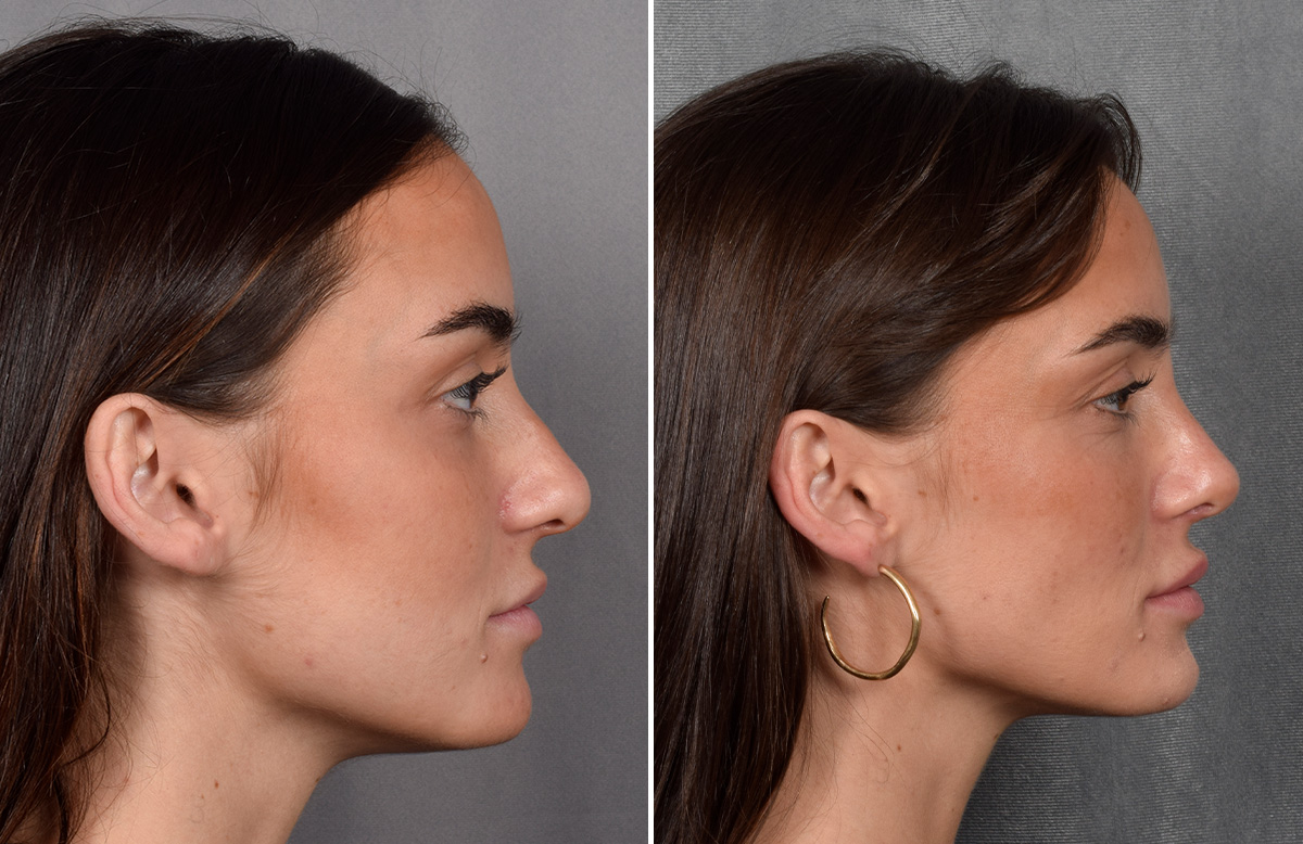 Rhinoplasty Before & After Gallery - Patient 315427 - Image 2