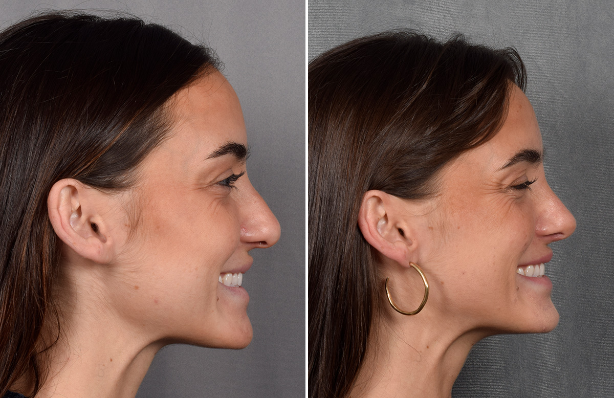 Rhinoplasty Before & After Gallery - Patient 315427 - Image 1
