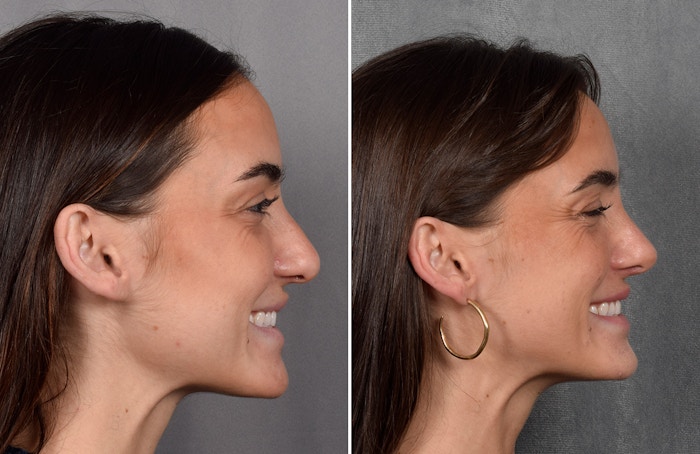 Rhinoplasty Before & After Gallery - Patient 315427 - Image 1