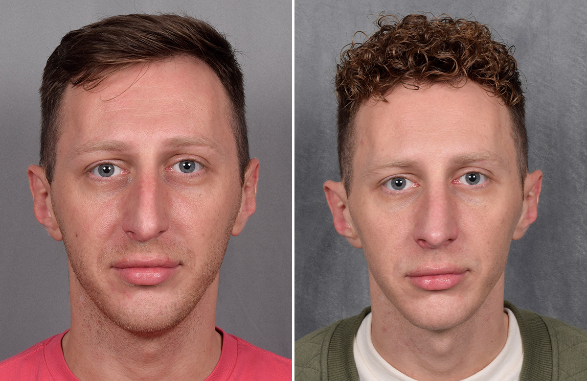 Rhinoplasty Before & After Gallery - Patient 225724 - Image 4