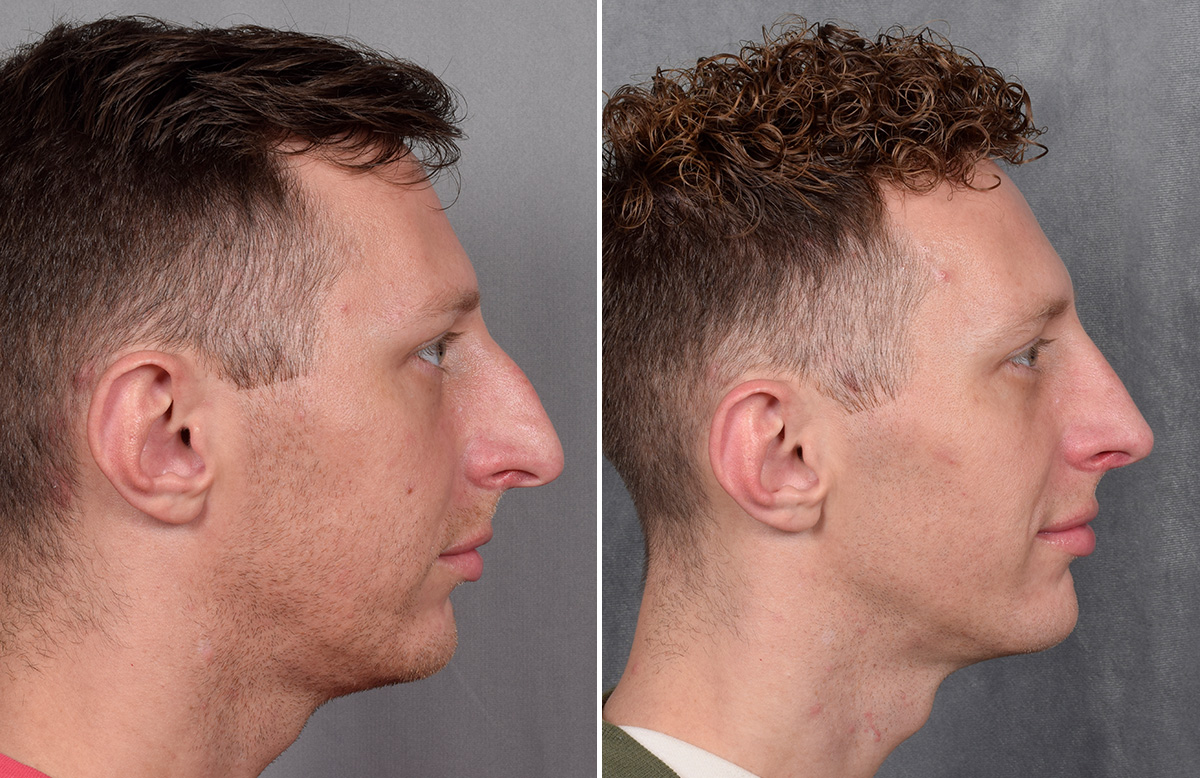 Rhinoplasty Before & After Gallery - Patient 225724 - Image 2