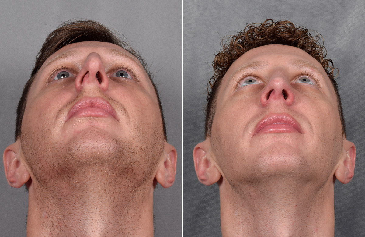 Rhinoplasty Before & After Gallery - Patient 225724 - Image 5