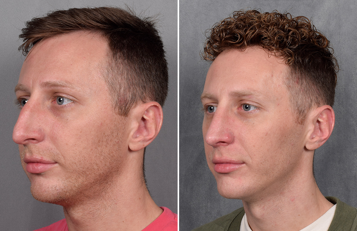 Rhinoplasty Before & After Gallery - Patient 225724 - Image 6