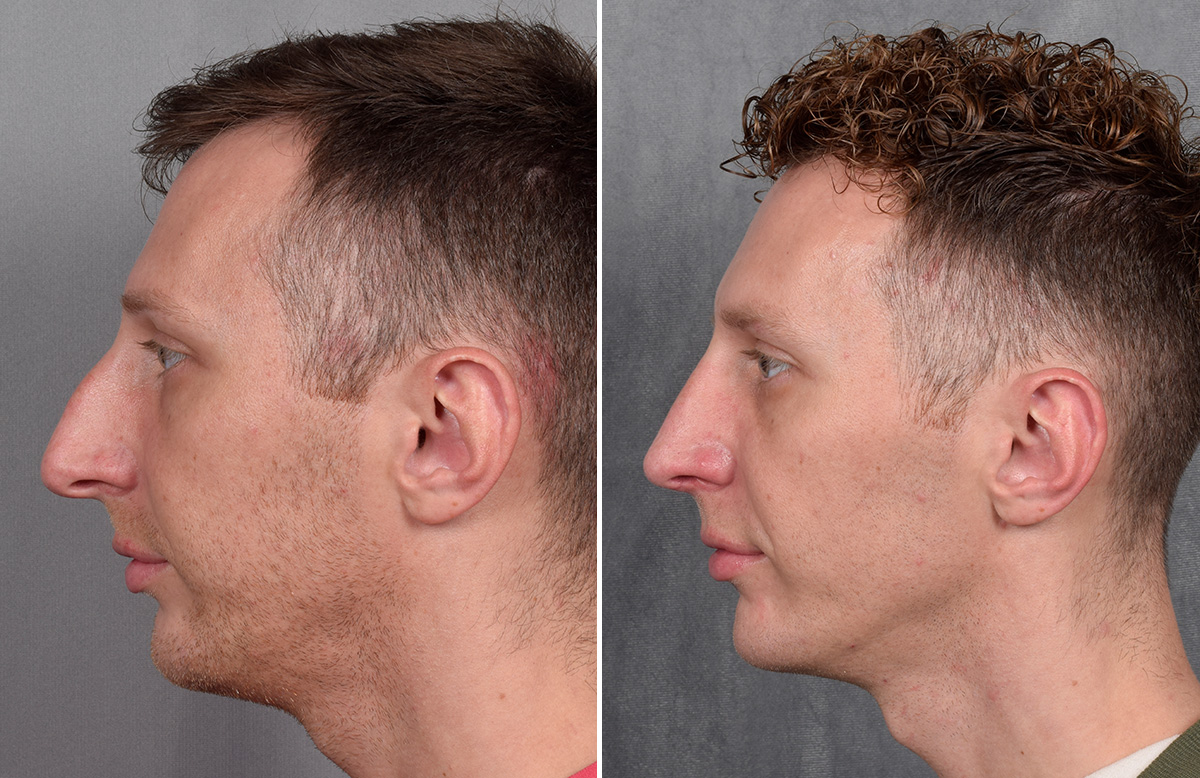 Rhinoplasty Before & After Gallery - Patient 225724 - Image 7