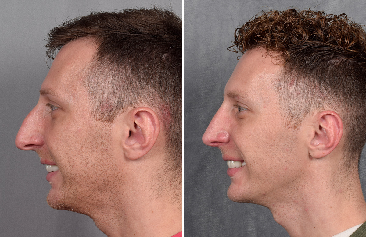 Rhinoplasty Before & After Gallery - Patient 225724 - Image 8