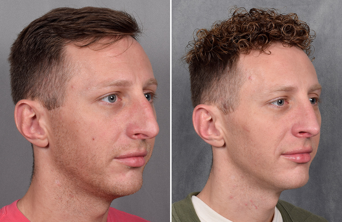 Rhinoplasty Before & After Gallery - Patient 225724 - Image 3