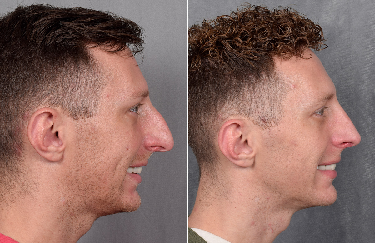Rhinoplasty Before & After Gallery - Patient 225724 - Image 1