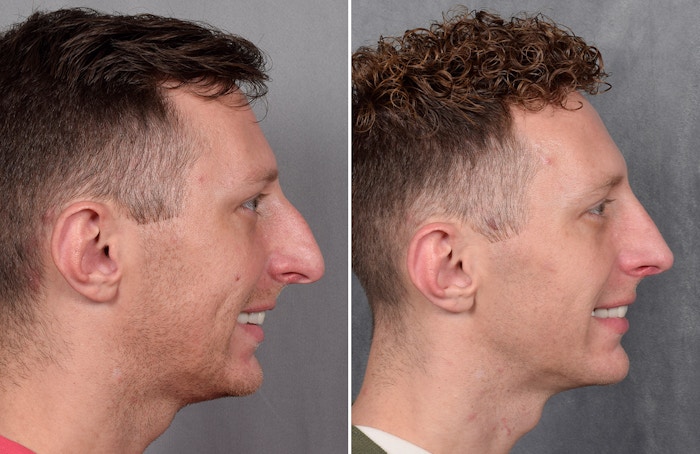 Rhinoplasty Before & After Gallery - Patient 225724 - Image 1