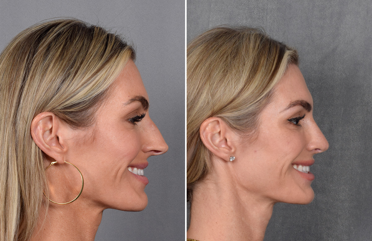 Rhinoplasty Before & After Gallery - Patient 111075 - Image 1