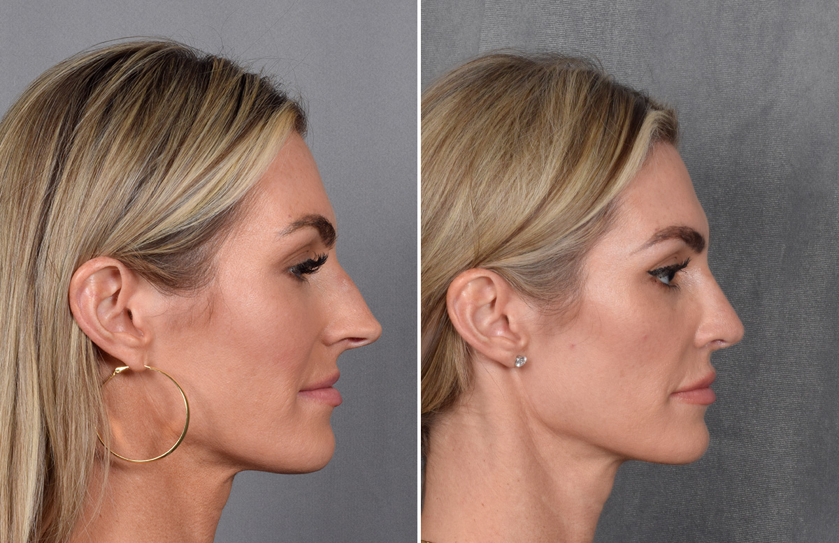 Rhinoplasty Before & After Gallery - Patient 111075 - Image 2