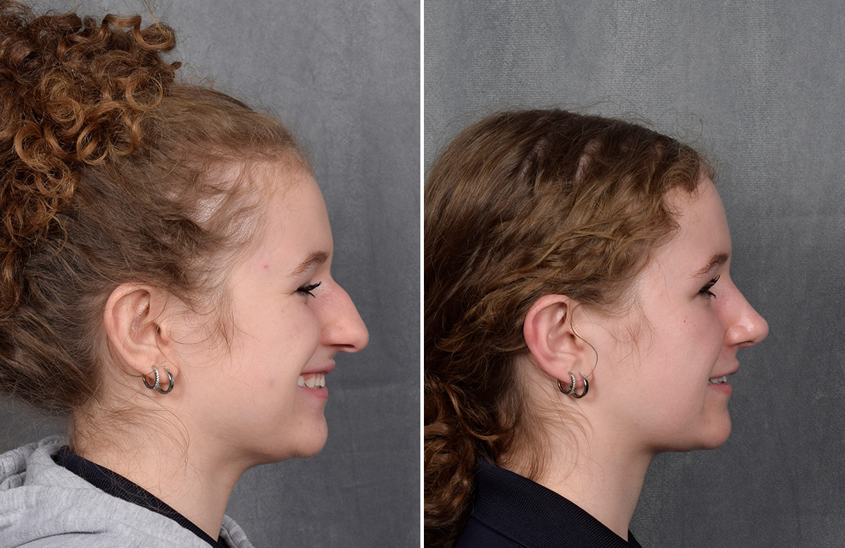 Rhinoplasty Before & After Gallery - Patient 102079 - Image 1