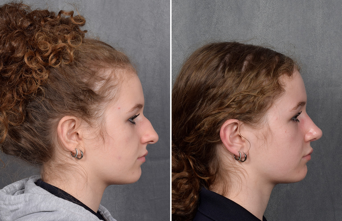 Rhinoplasty Before & After Gallery - Patient 102079 - Image 2