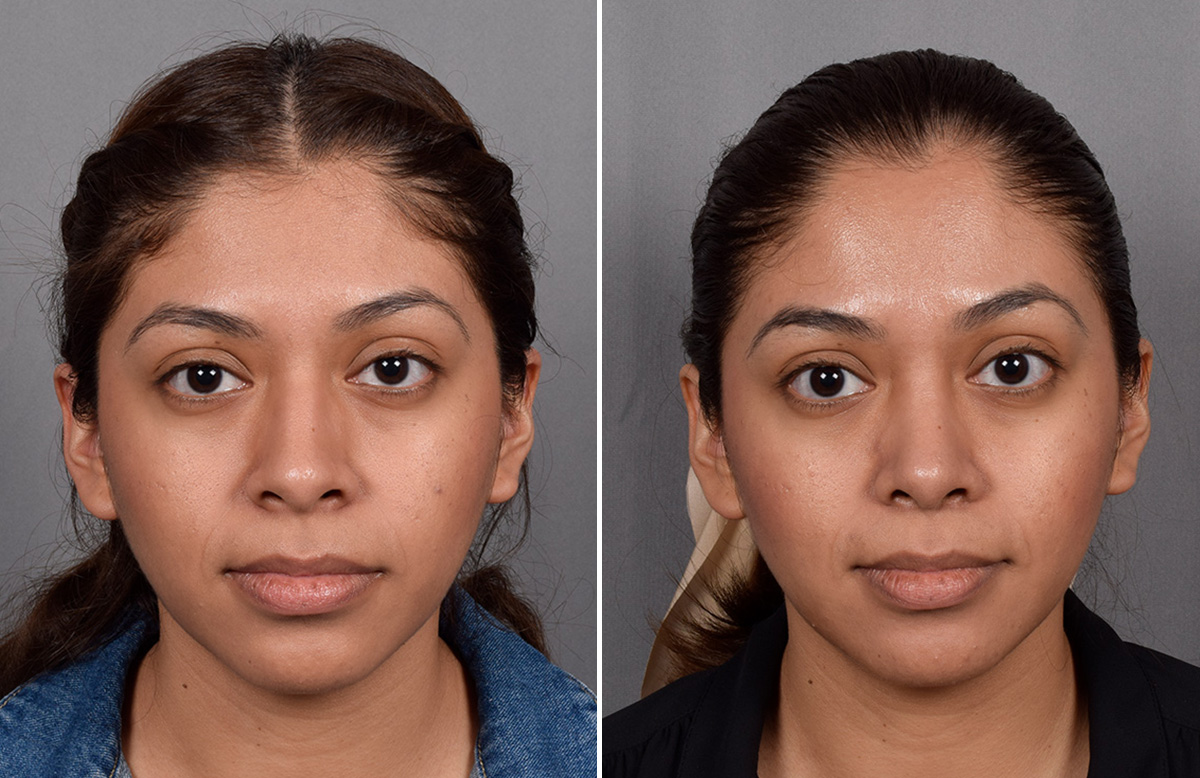 Rhinoplasty Before & After Gallery - Patient 315439 - Image 4