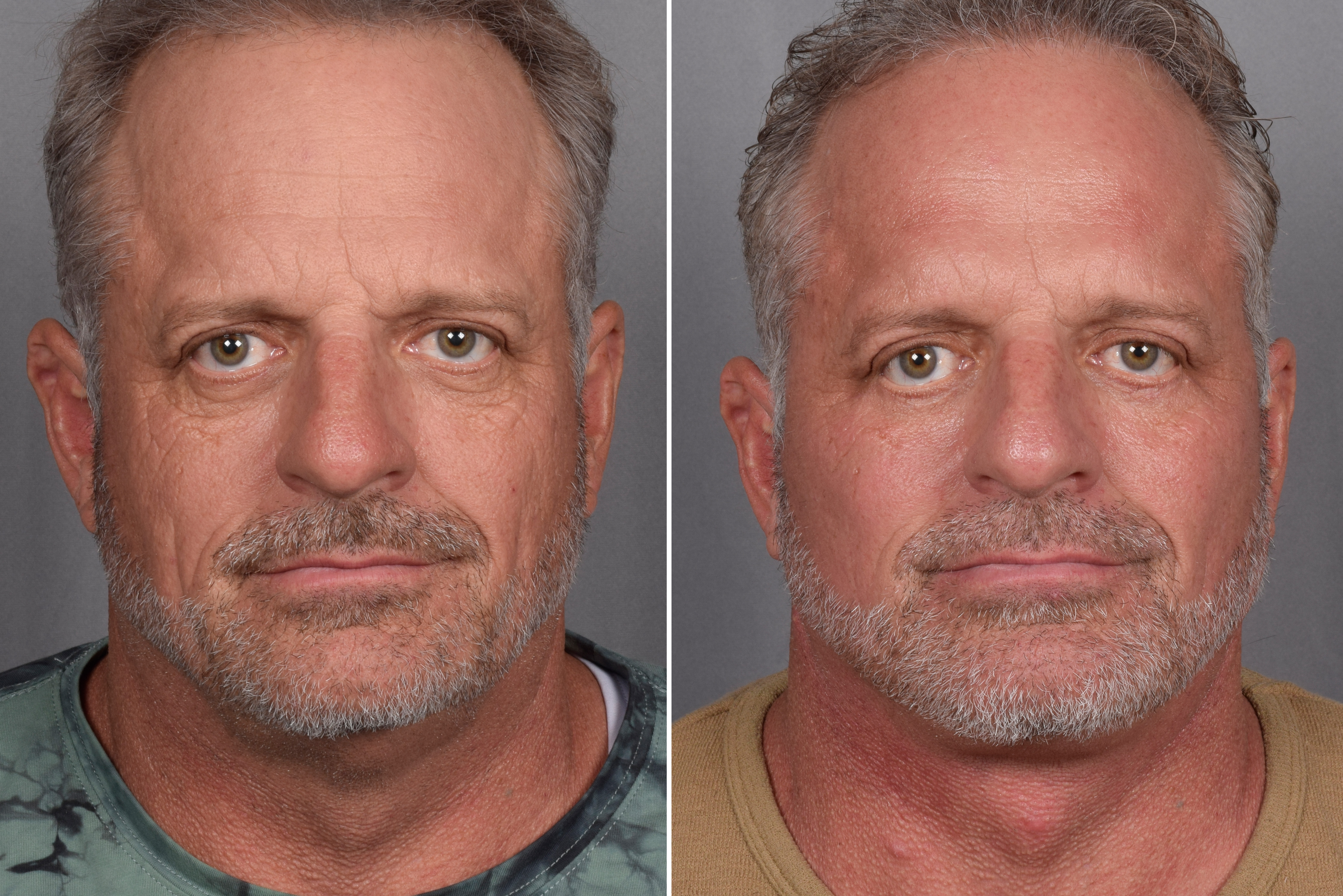 Facelift Before & After Gallery - Patient 337697 - Image 3