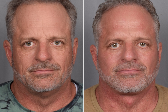 Facelift Before & After Gallery - Patient 337697 - Image 1
